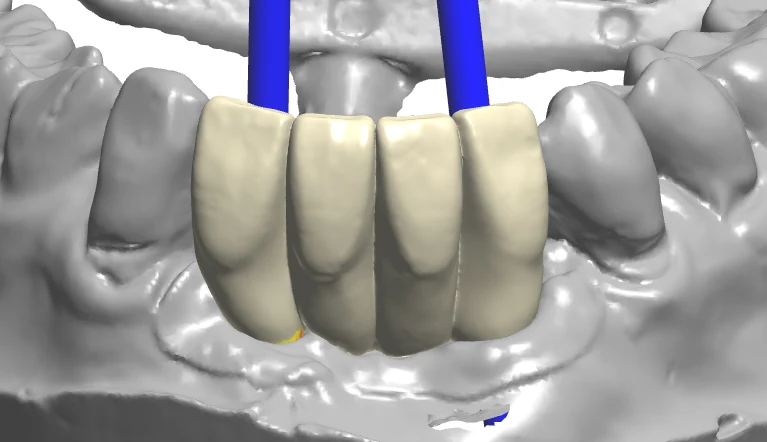 Custom abutment geometry shown in a digital design view