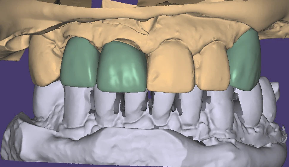 Close view of dental CAD geometry and restoration detail