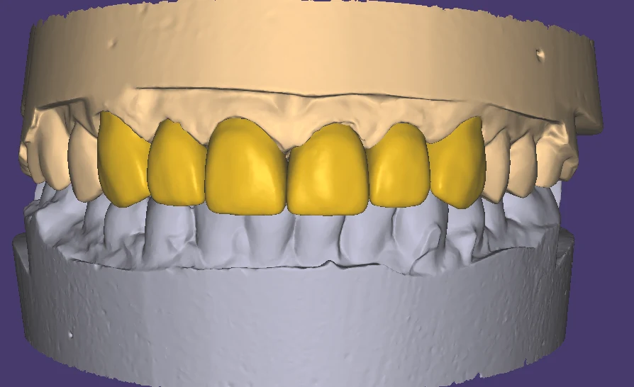 Full-arch restorative design in a dental CAD workspace